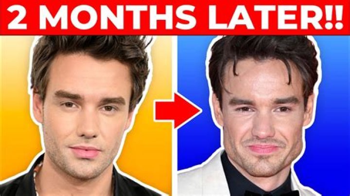 Liam Payne's Facial Surgery: A Deeper Dive into Aesthetics and Recovery