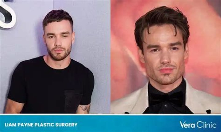 Liam Payne's Plastic Surgery Journey: A Detailed Exploration