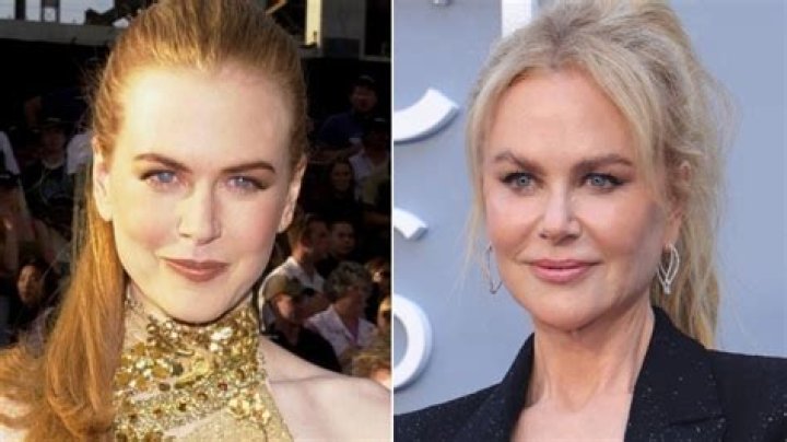 The Ultimate Guide to Nicole Kidman's Cosmetic Surgery Journey