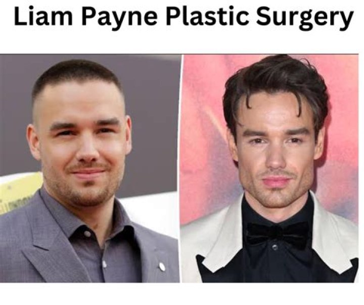 The Untold Truth of Liam Payne's Plastic Surgery Journey