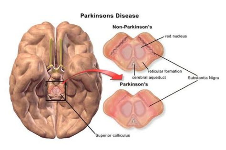 Unraveling the Mystery: Does Mark Levine Have Parkinson's?
